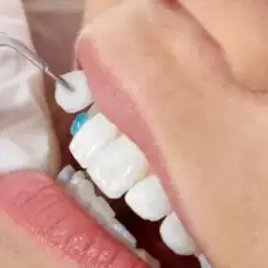 Bọc răng sứ có phải lấy tủy không ? Lấy tủy răng có đau không ?